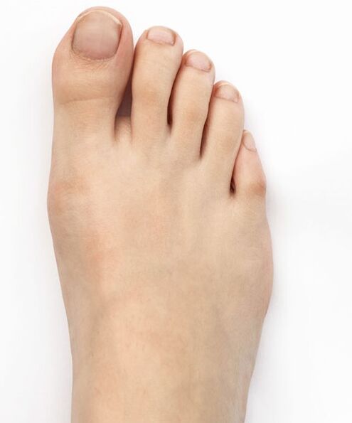 Išgydžiau nykščio valgus purškikliu Hondro Sol Valgus