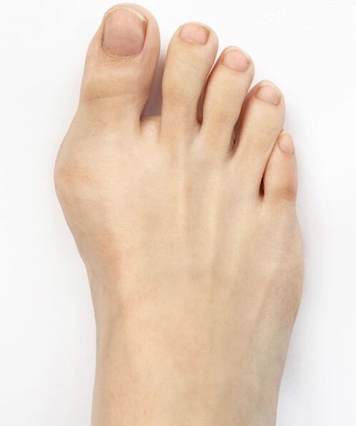 hallux valgus prieš naudojant Hondro Sol Valgus purškalą