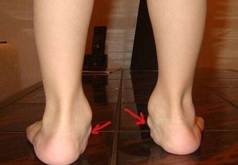 Vaikų pėdų deformacija Valgus