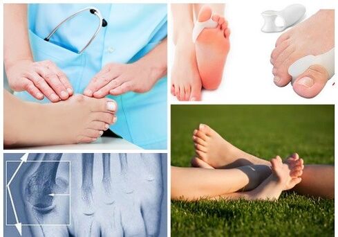 Valgus deformacijos gydymas