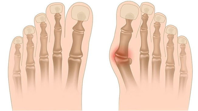 Valgus deformacijos gydymas