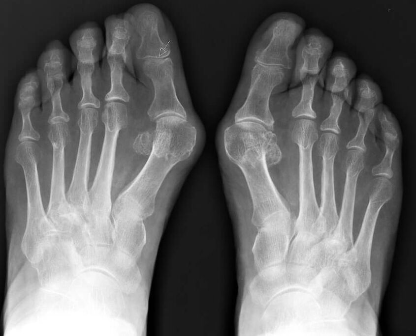 Hallux valgus rentgeno nuotrauka